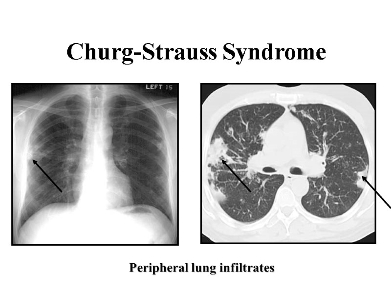 Churg-Strauss Syndrome Peripheral lung infiltrates